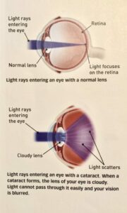 Eye graphic Credit: American Academy of Ophthalmology